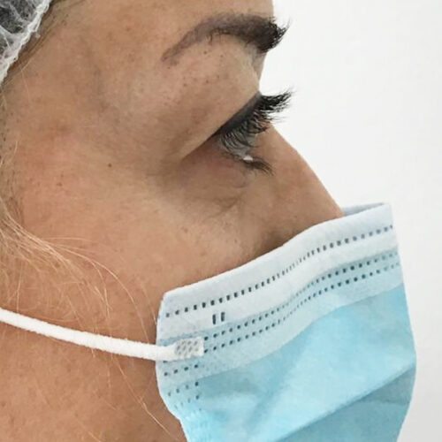 Antes d ela blefaroplastia, la paciente tiene el párpado superior caído y encapotado.