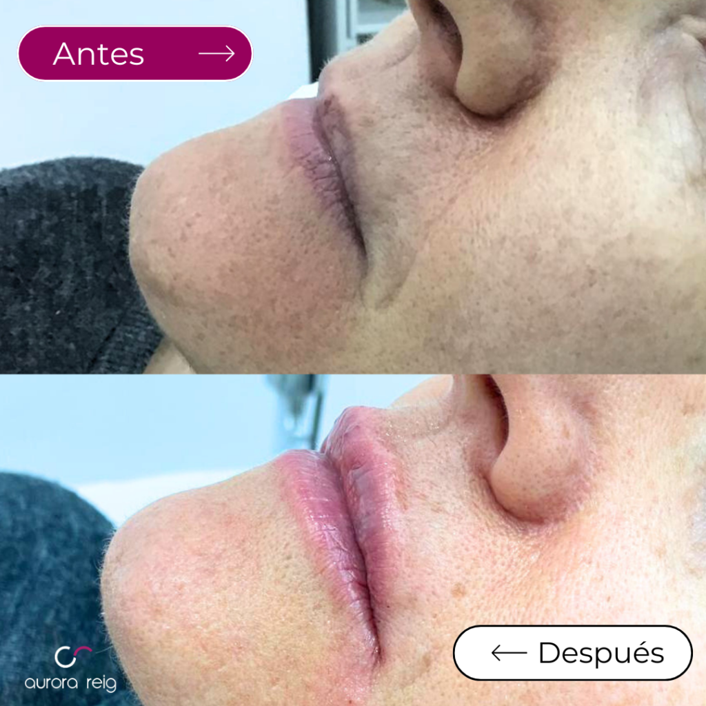 Aumento de labios Valencia