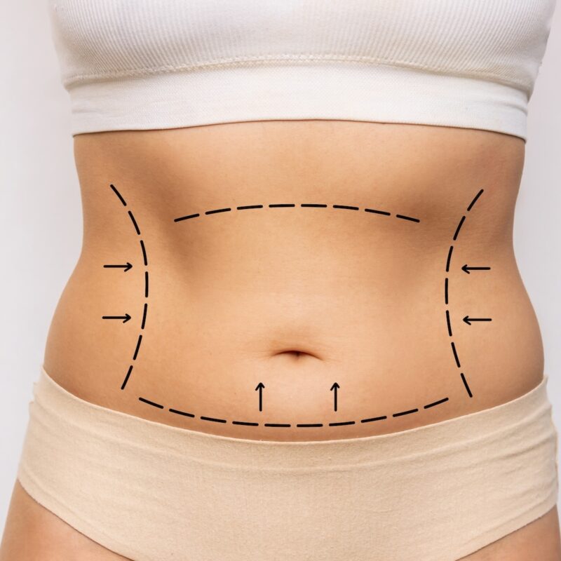 abdominoplastia valencia