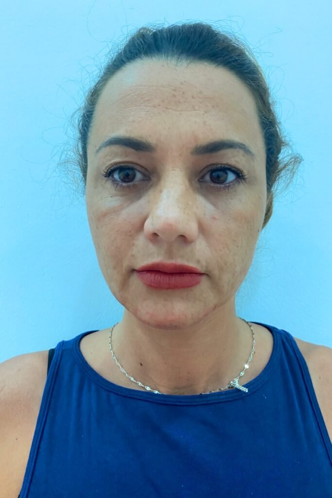 antes relleno arco mandibular